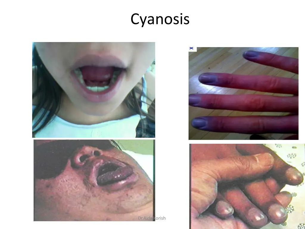 cyanosis
