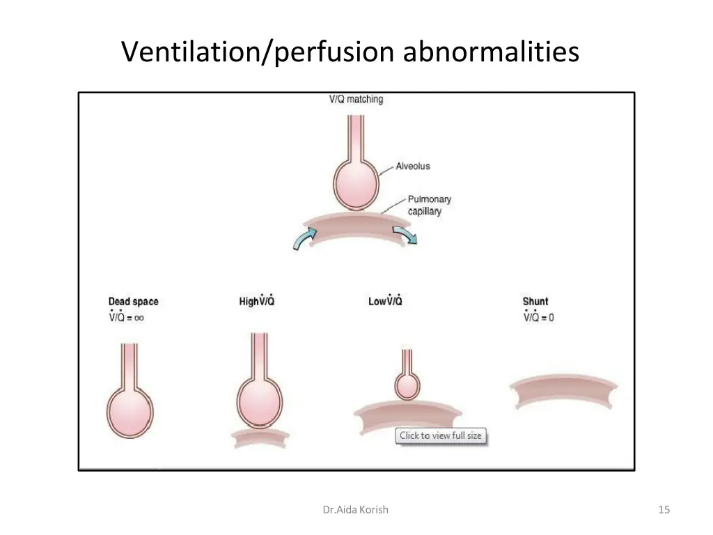 ventilation perfusion abnormalities