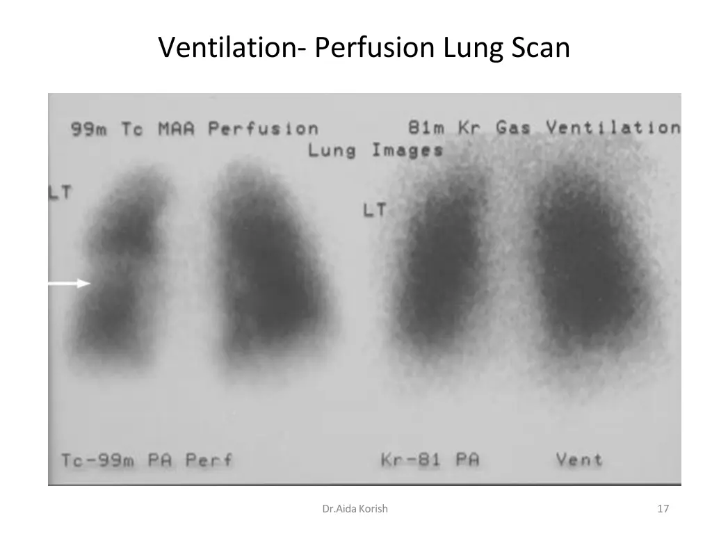 ventilation perfusion lung scan