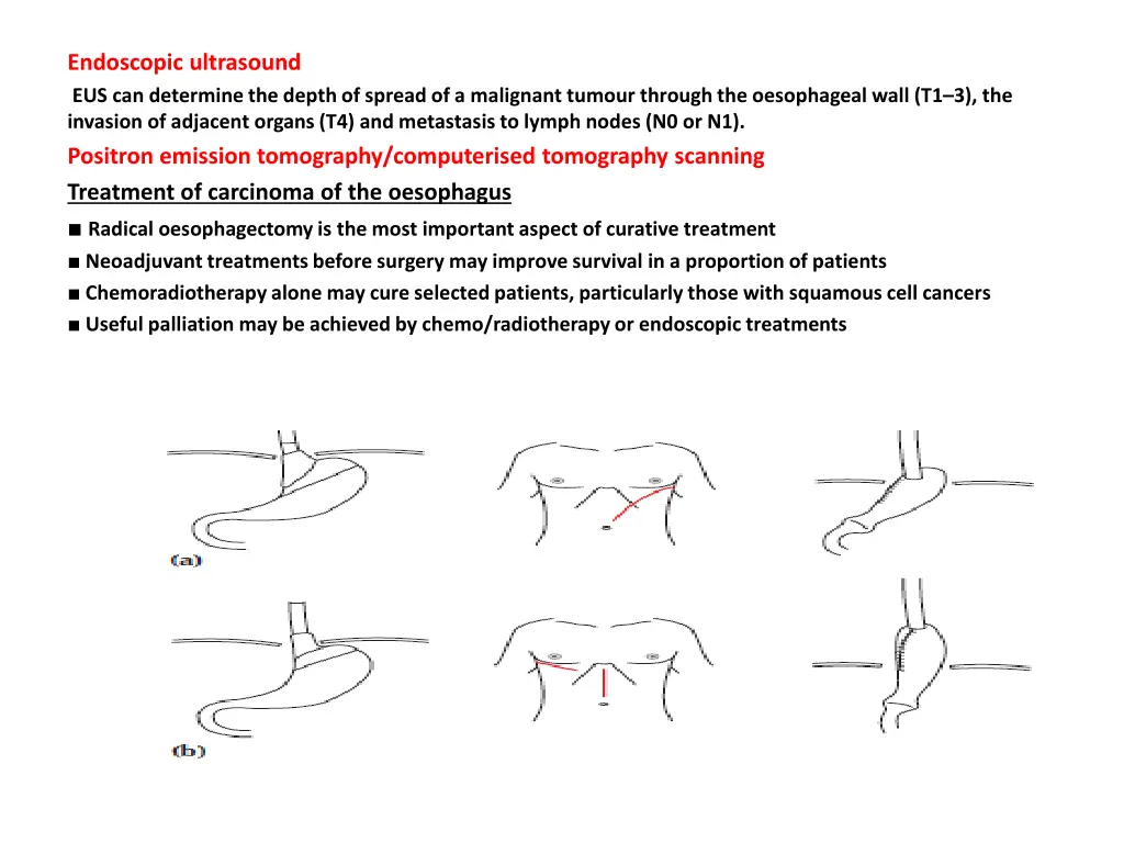 endoscopic ultrasound eus can determine the depth