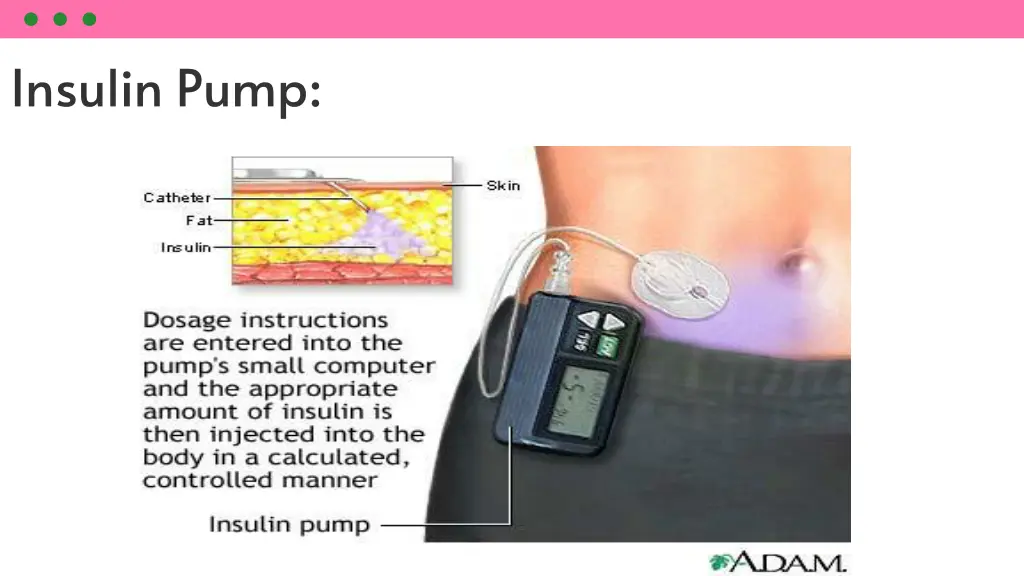 insulin pump