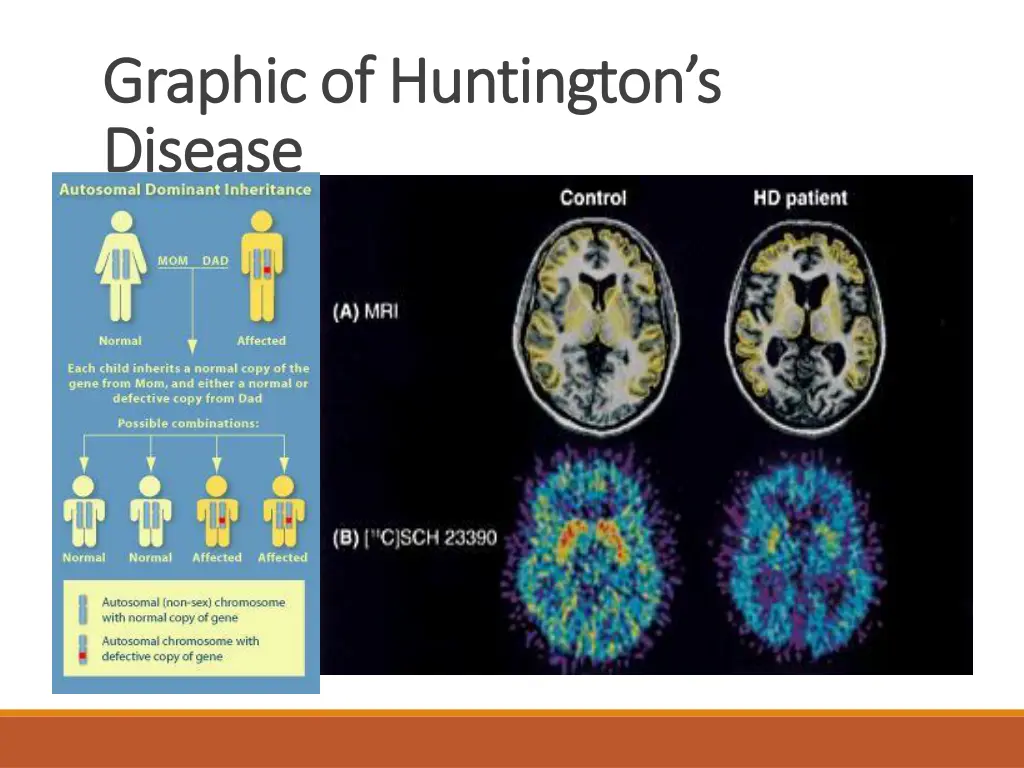 graphic of huntington s graphic of huntington