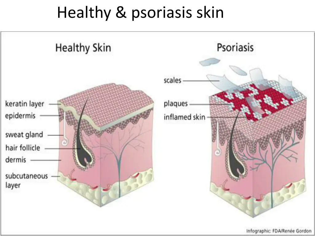 healthy psoriasis skin
