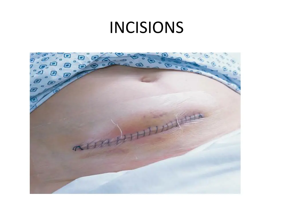 incisions