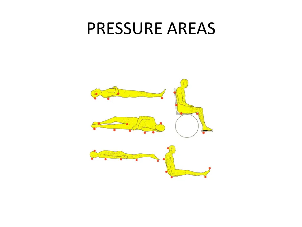 pressure areas