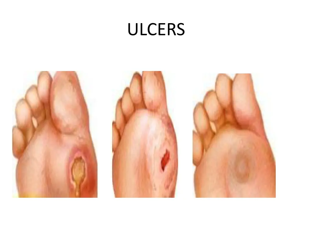 ulcers