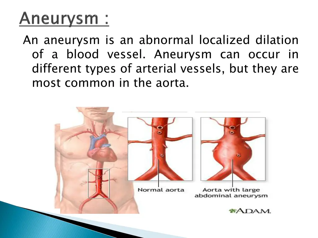 an aneurysm is an abnormal localized dilation