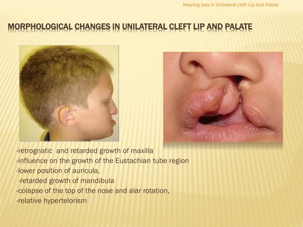hearing loss in unilateral cleft lip and palate 4