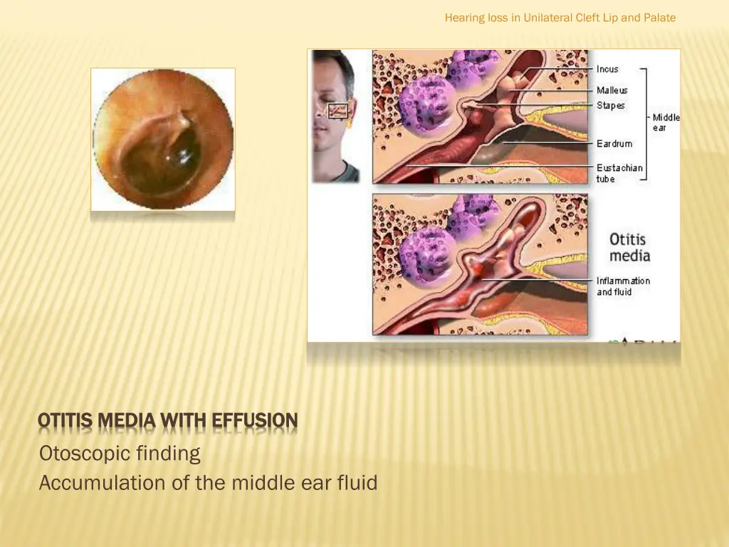 hearing loss in unilateral cleft lip and palate 6