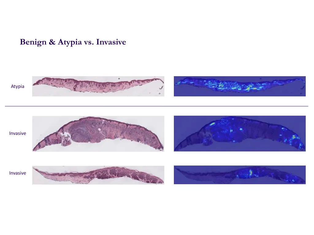 benign atypia vs invasive