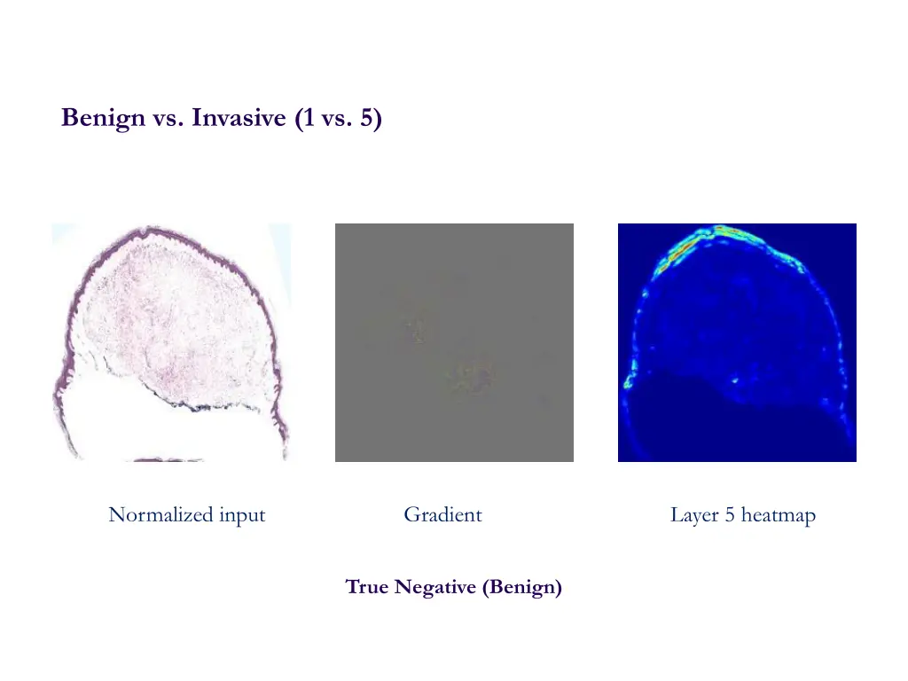 benign vs invasive 1 vs 5 1