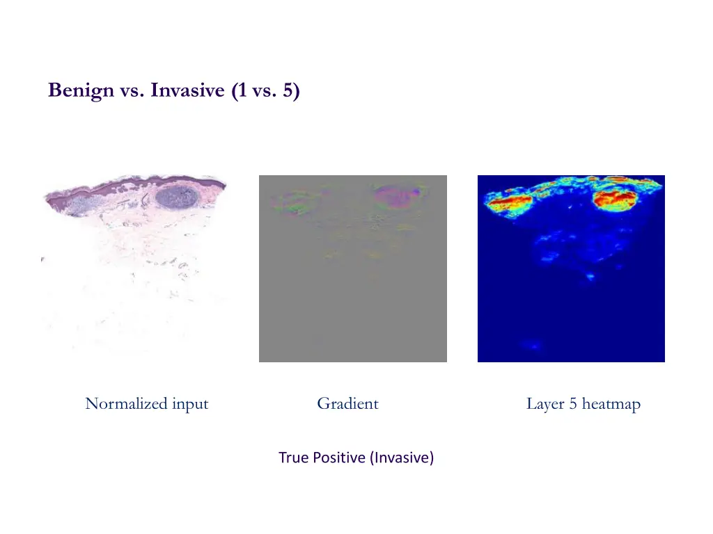benign vs invasive 1 vs 5