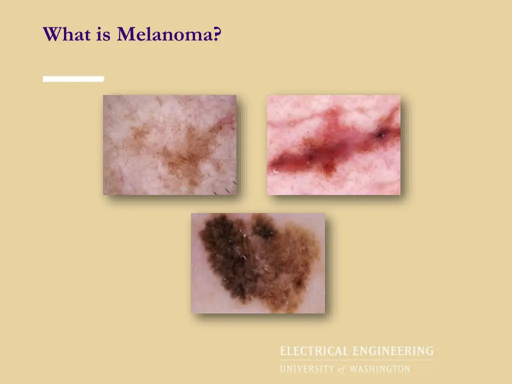 what is melanoma