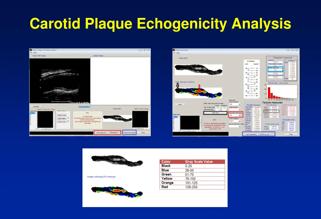 carotid plaque echogenicity analysis