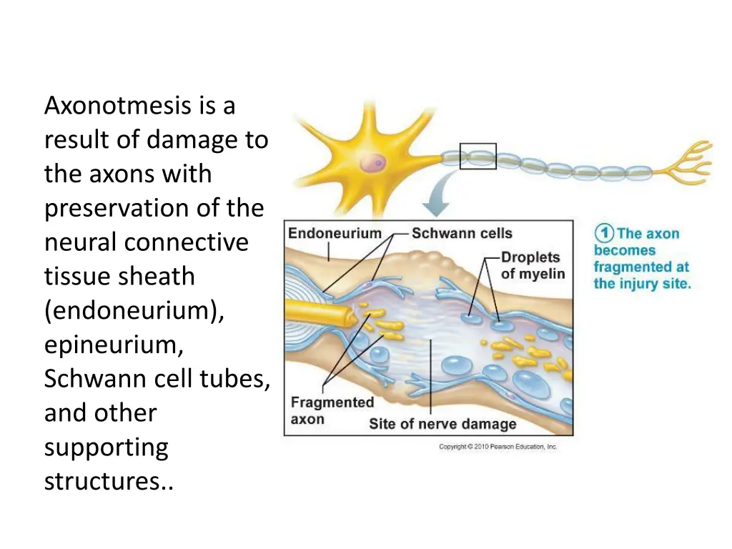 axonotmesis is a result of damage to the axons
