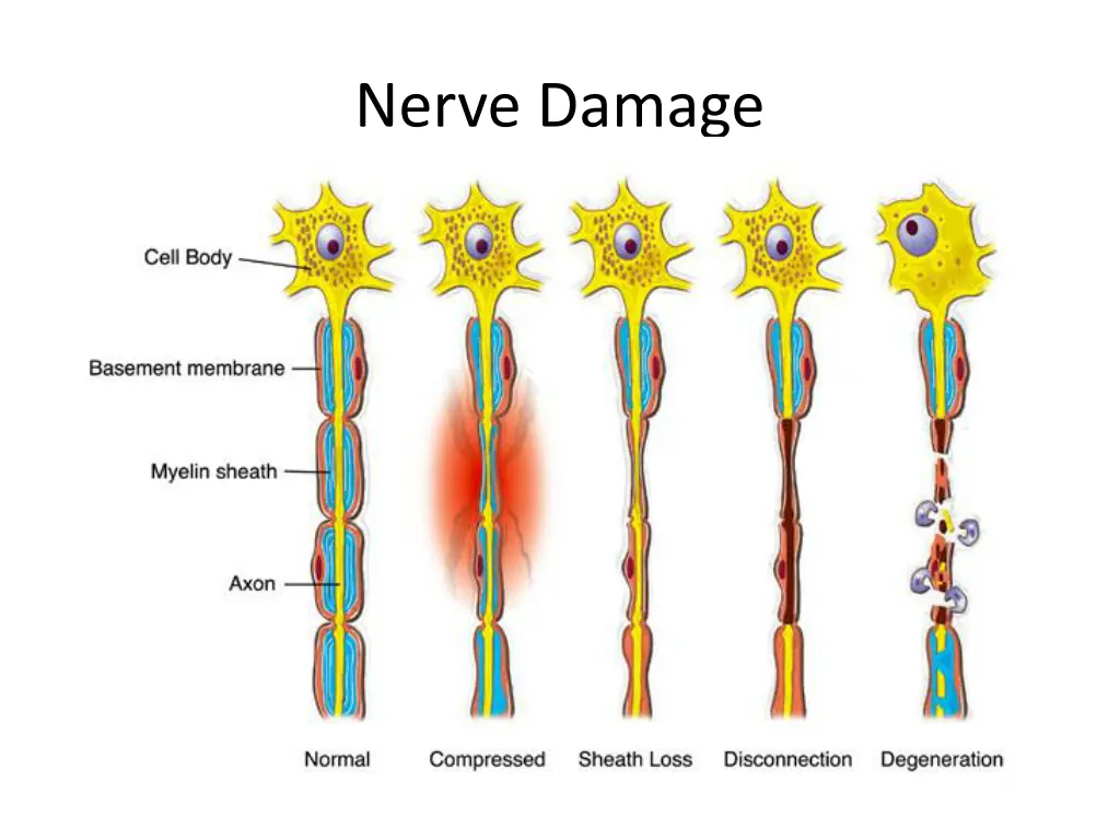 nerve damage