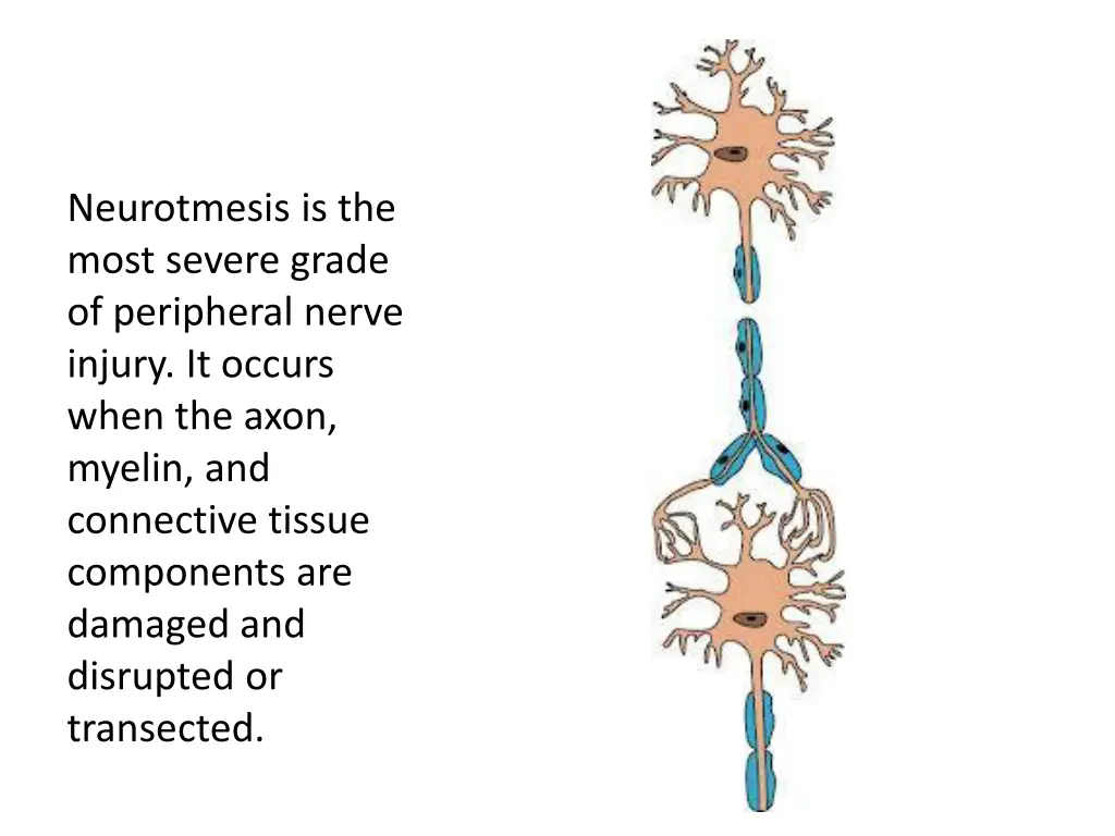 neurotmesis is the most severe grade