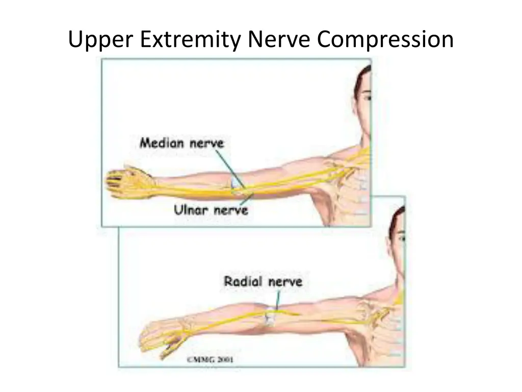 upper extremity nerve compression