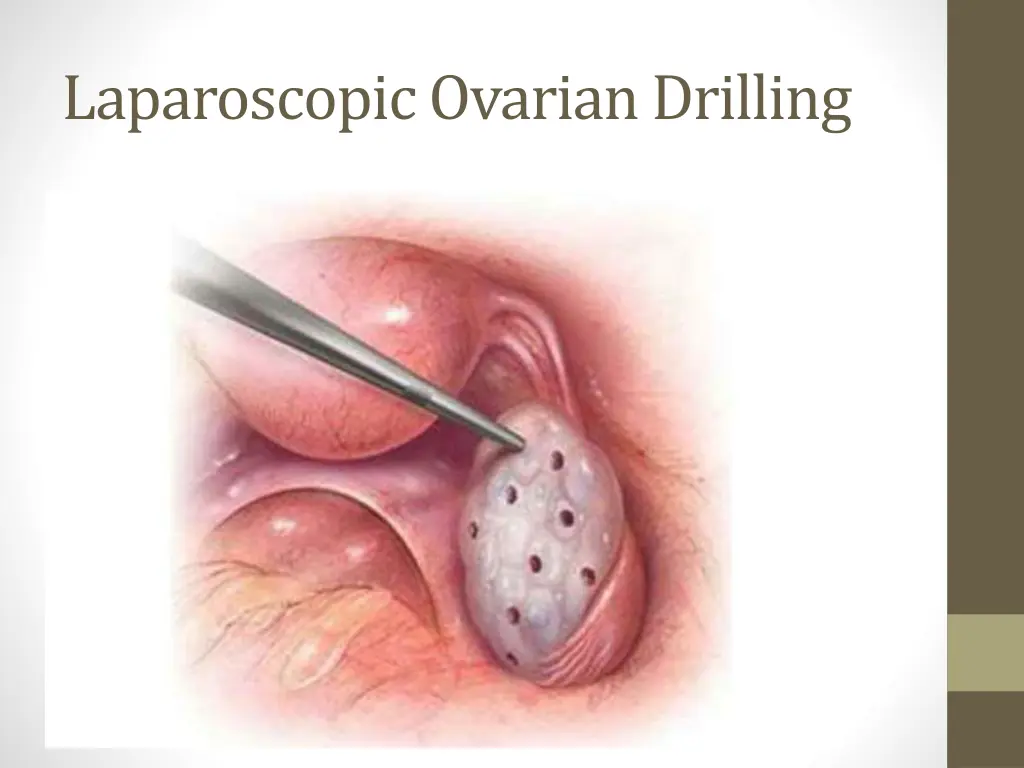 laparoscopic ovarian drilling
