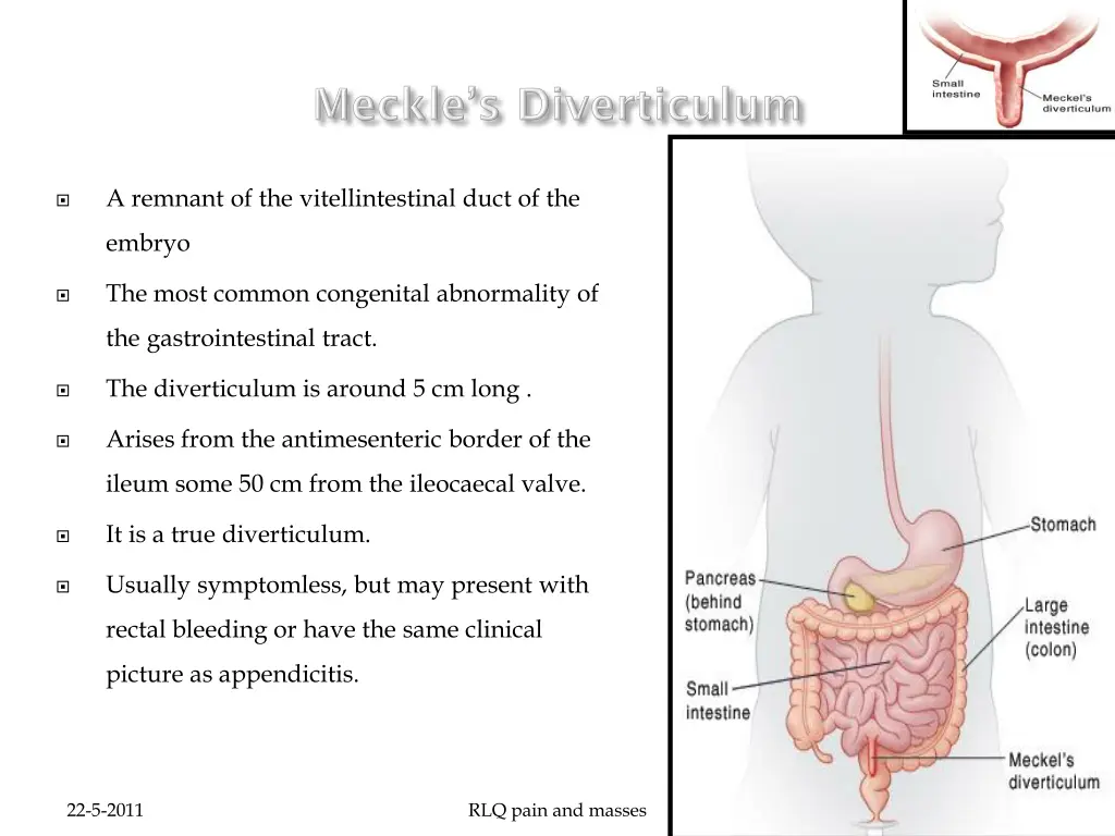 a remnant of the vitellintestinal duct of the