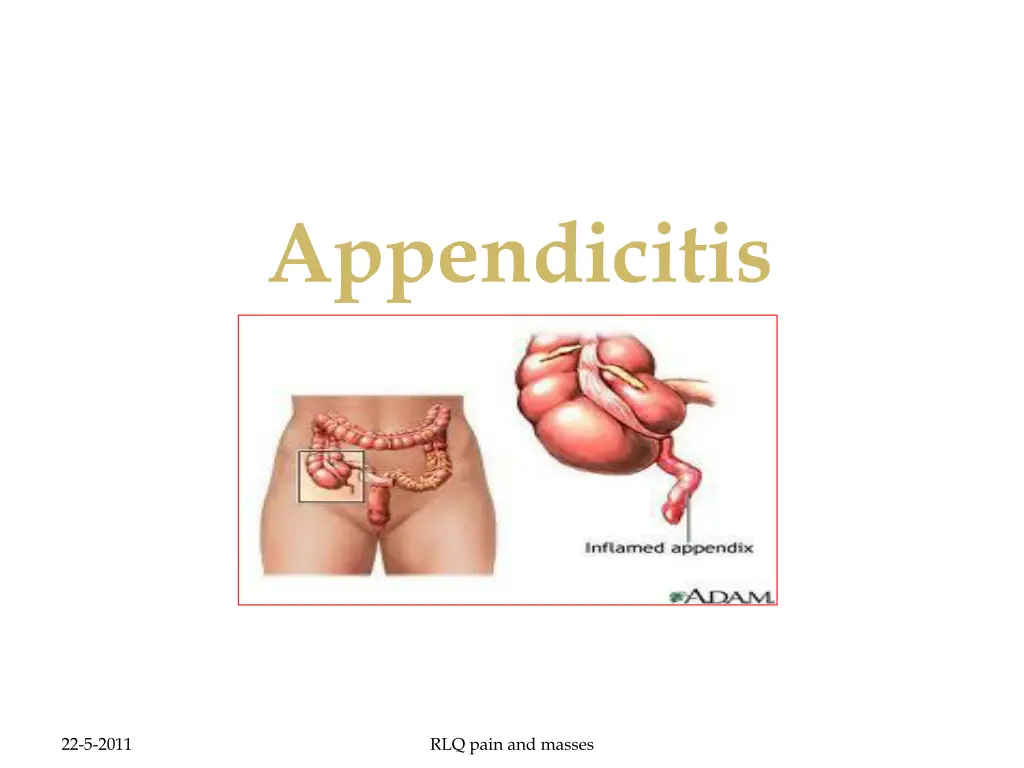 appendicitis 1