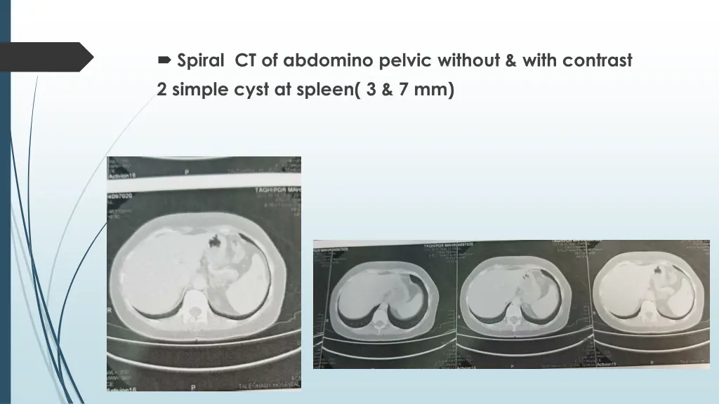 spiral ct of abdomino pelvic without with