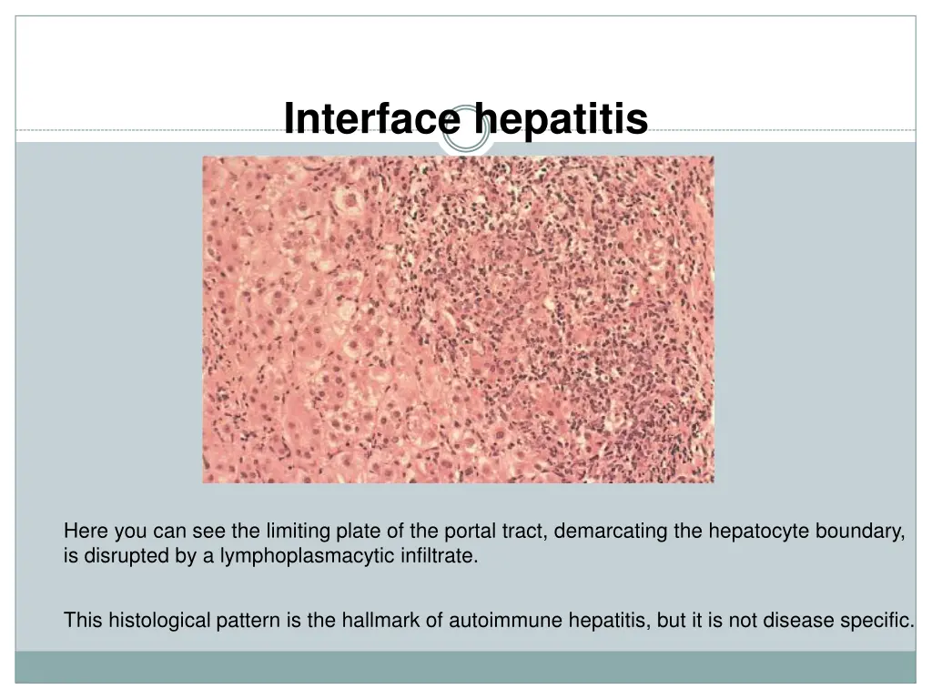 interface hepatitis