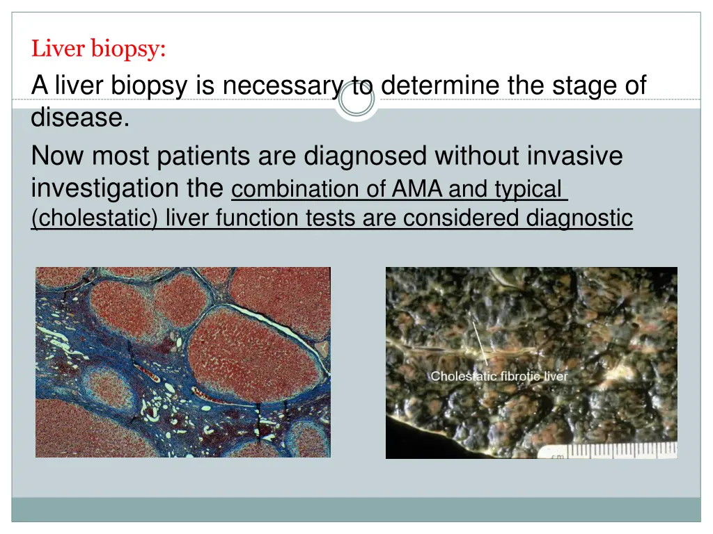 liver biopsy a liver biopsy is necessary