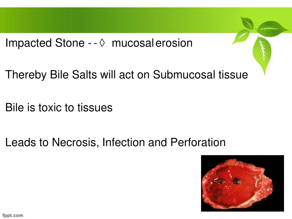impacted stone mucosalerosion