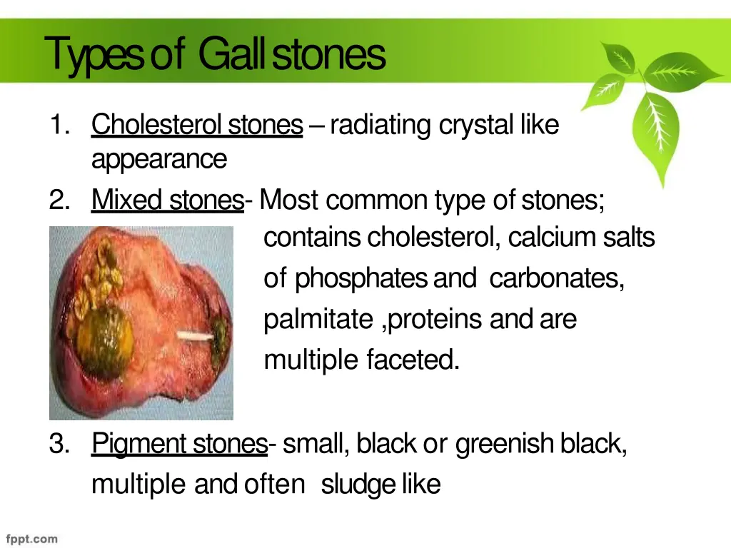 types of gallstones