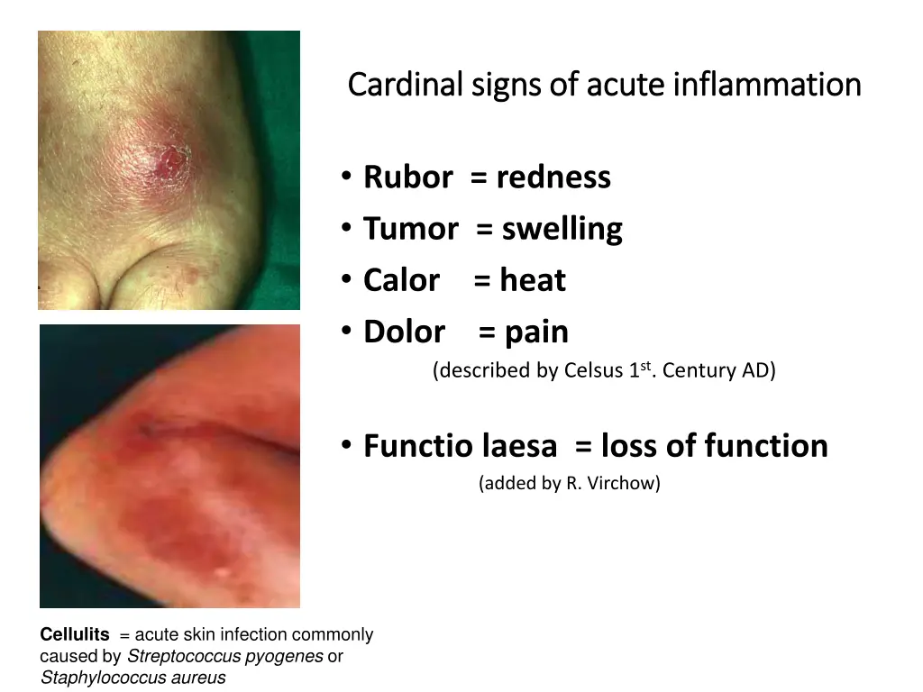 cardinal signs of acute inflammation cardinal