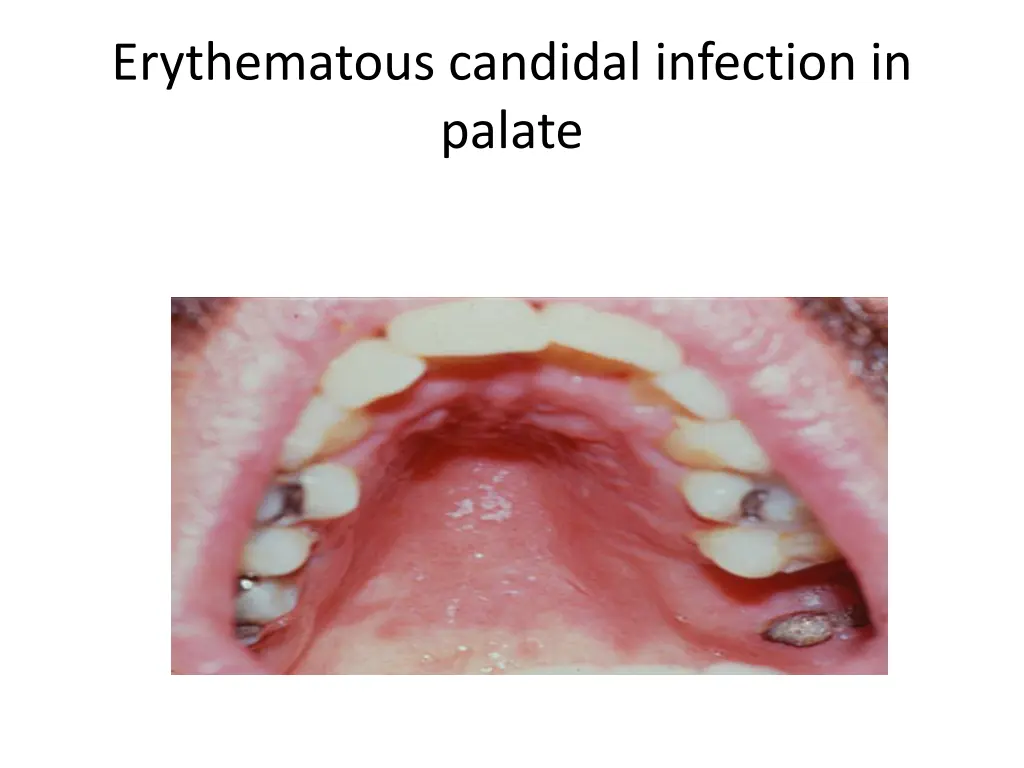 erythematous candidal infection in palate