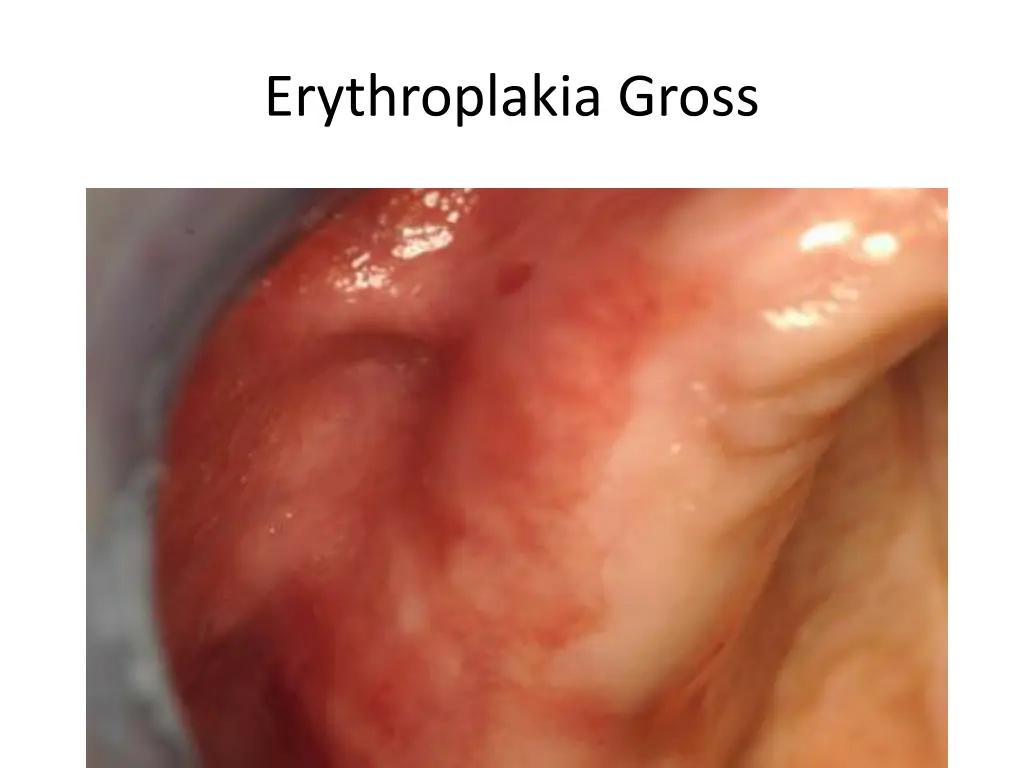 erythroplakia gross