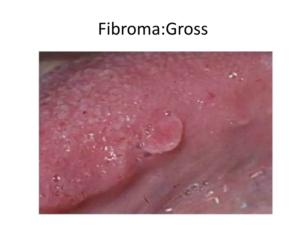fibroma gross