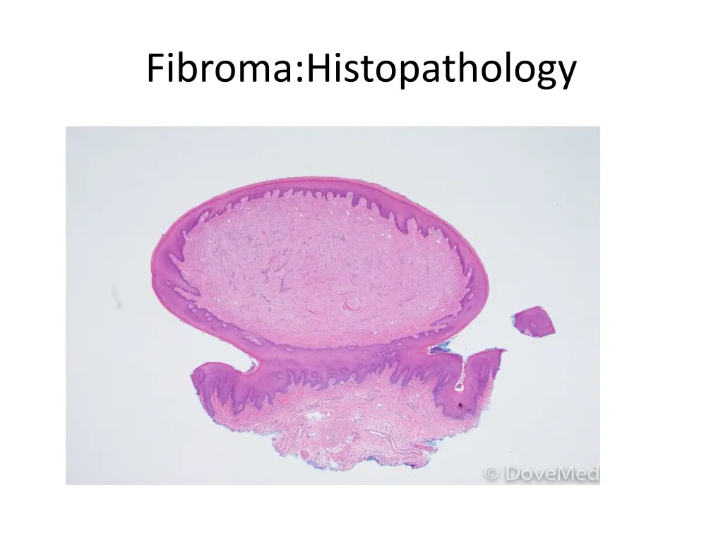 fibroma histopathology