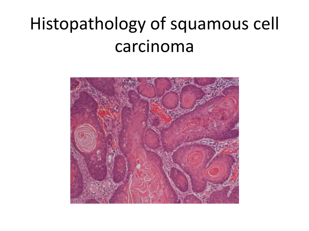 histopathology of squamous cell carcinoma