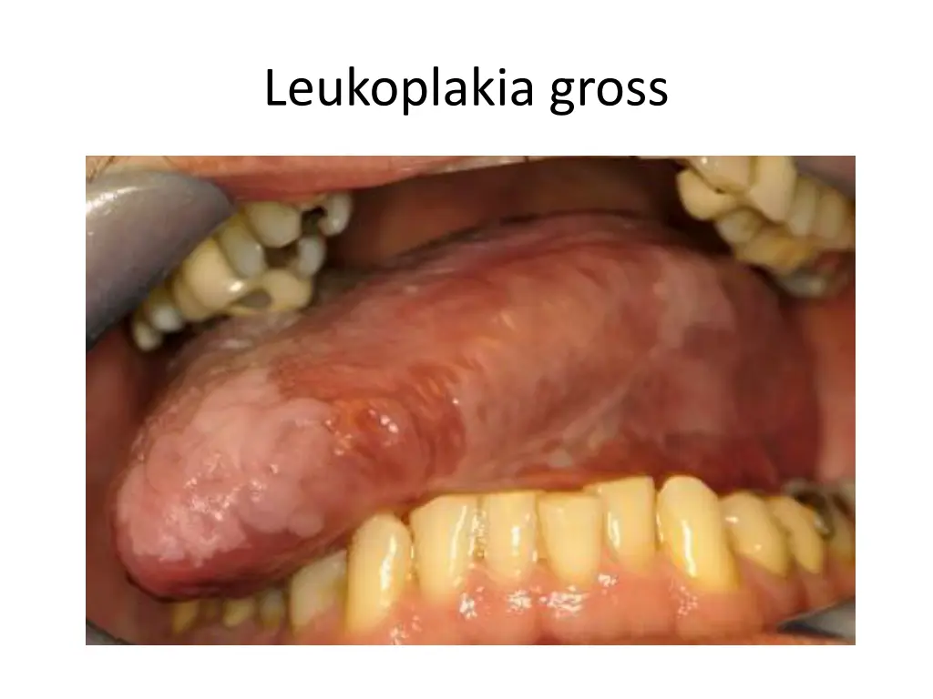 leukoplakia gross