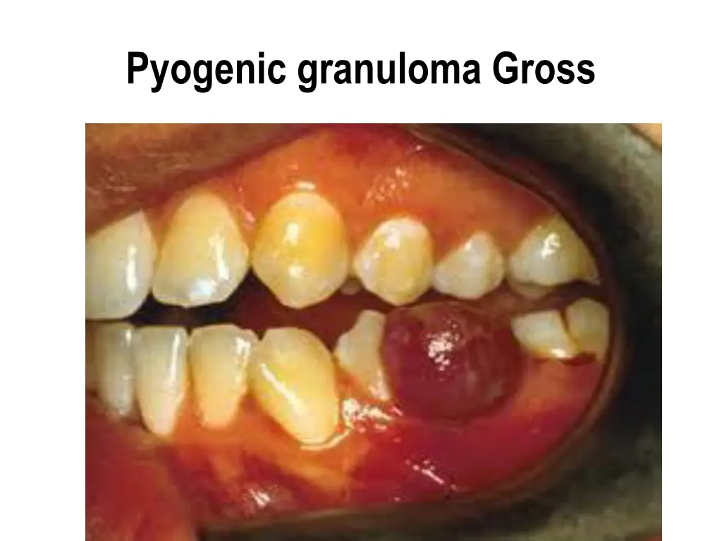 pyogenic granuloma gross