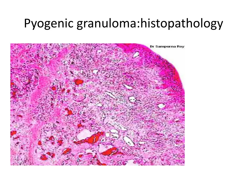 pyogenic granuloma histopathology