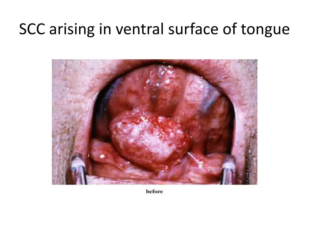 scc arising in ventral surface of tongue