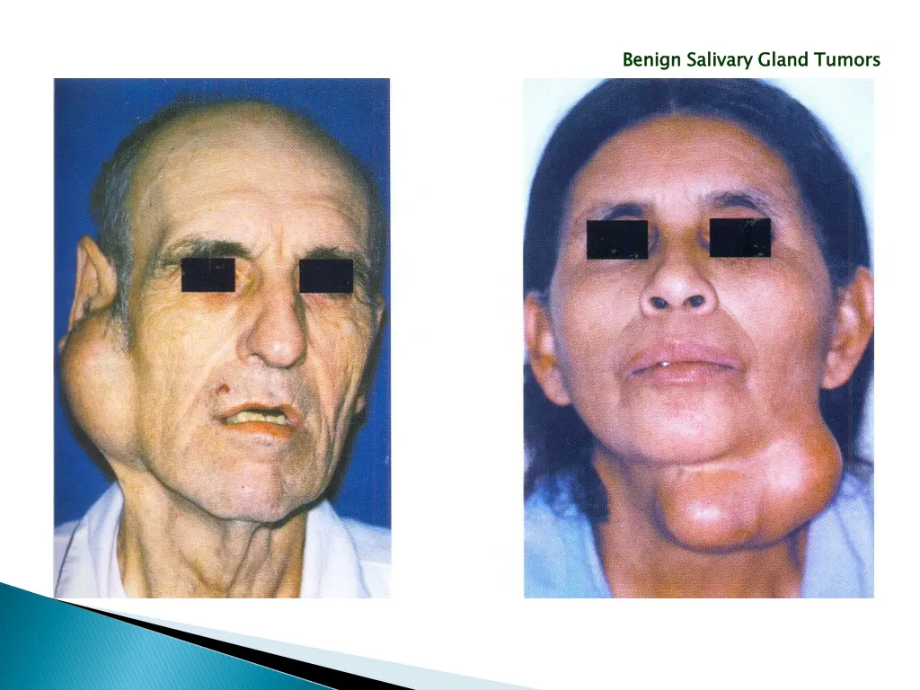 benign salivary gland tumors