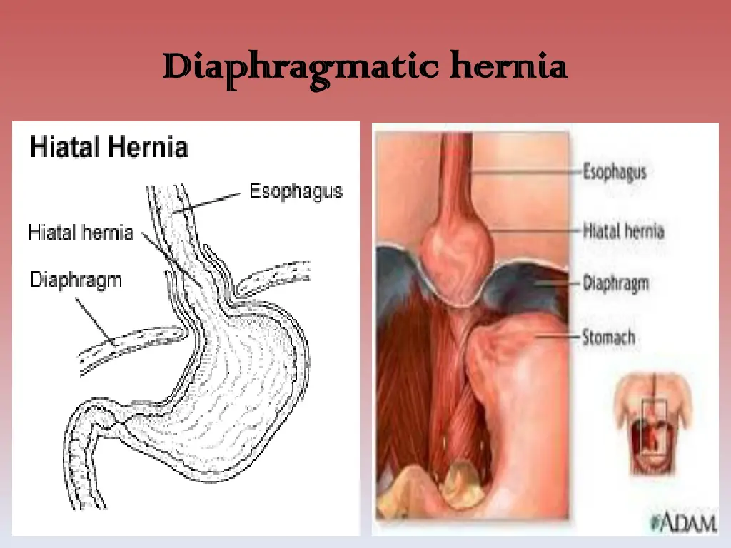 diaphragmatic hernia diaphragmatic hernia