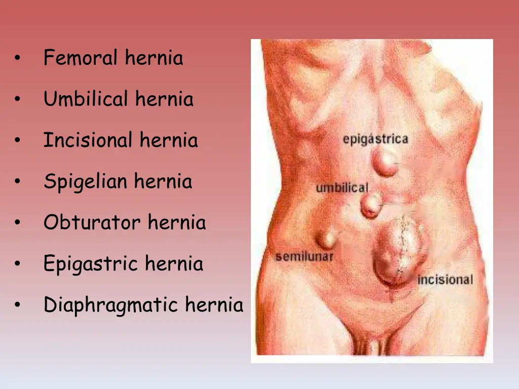 femoral hernia