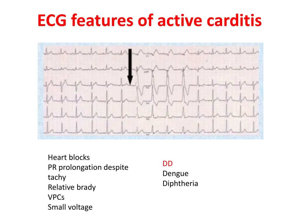 ecg features of active carditis