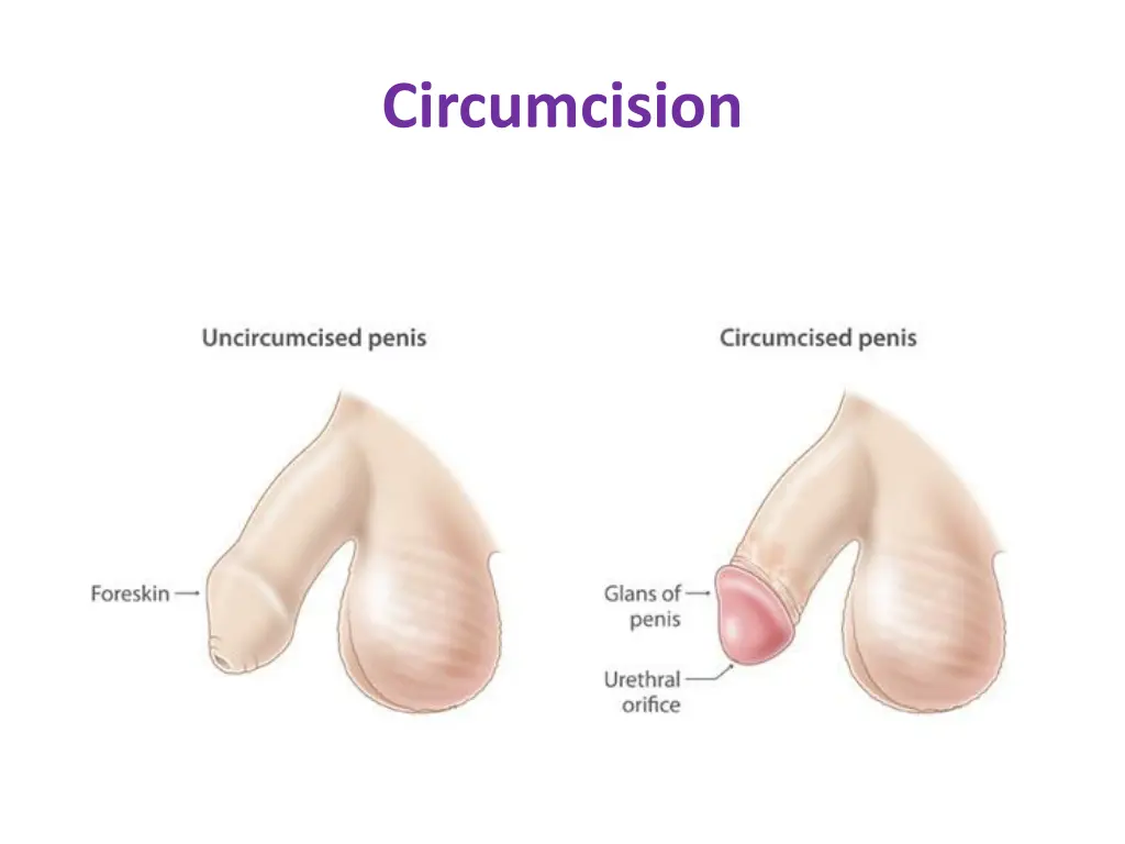 circumcision 1