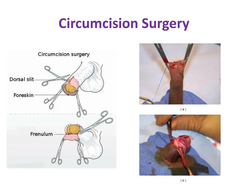 circumcision surgery
