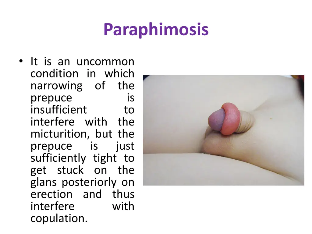 paraphimosis