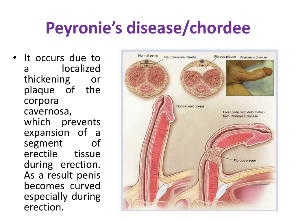 peyronie s disease chordee