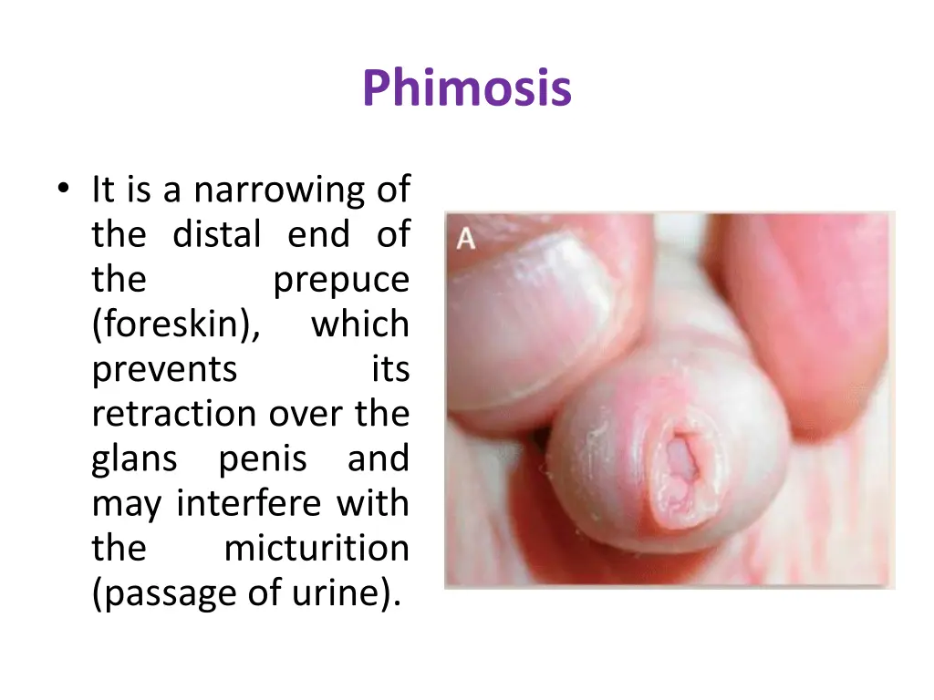 phimosis