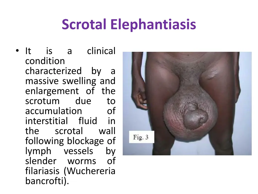 scrotal elephantiasis